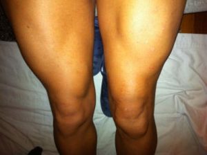 atrofia muscular e eletroestimulação. atrofia muscular perna